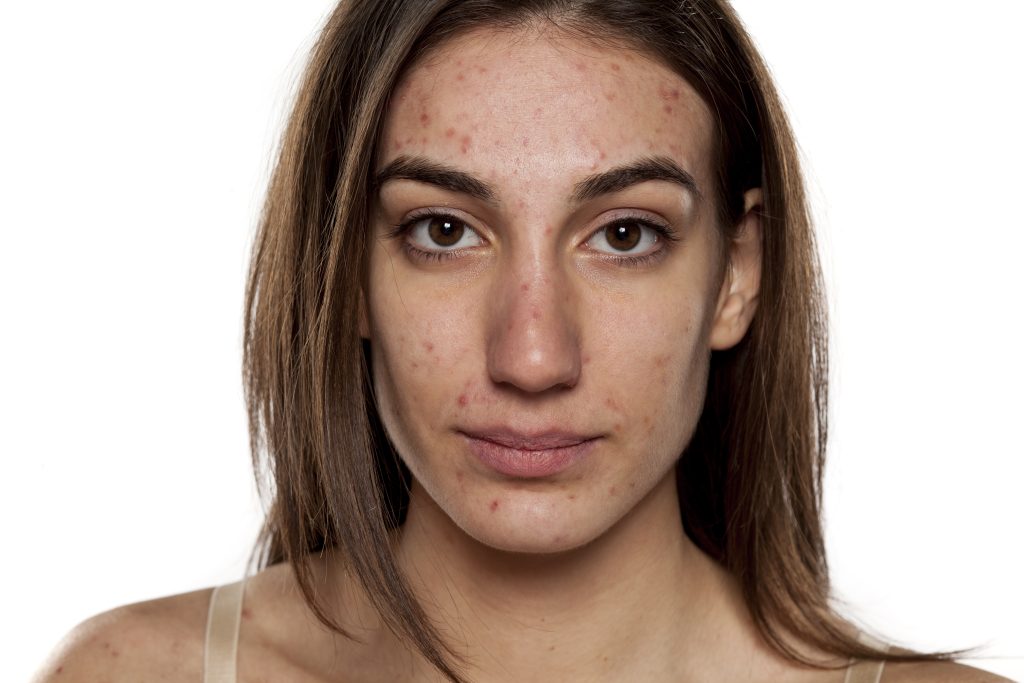 Ung kvinna med akne i ansiktet och på axlarna.